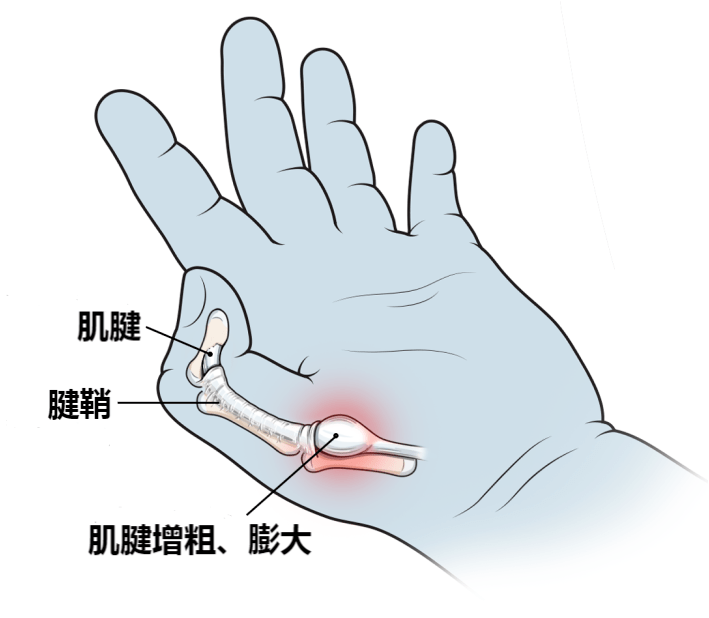 拇指处于过度屈曲状态,在掌指关节腱鞘入口处,腱鞘会长时间压迫肌腱