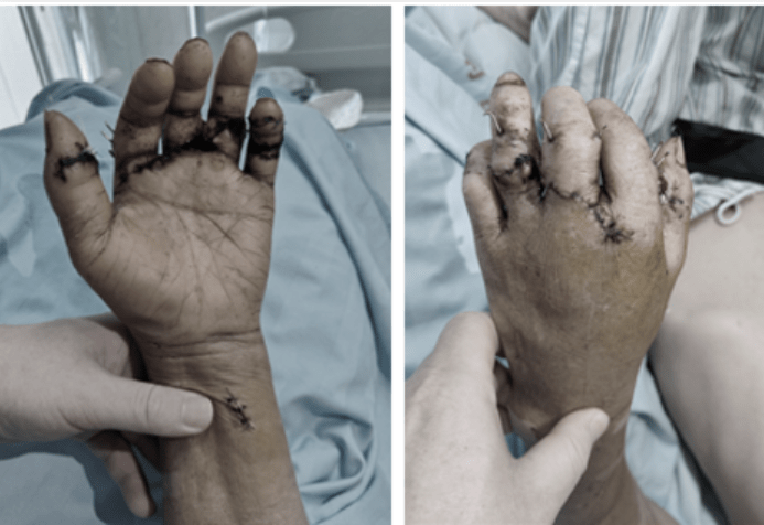 广州专家"马拉松"手术挽救断指_血管_中指_断肢