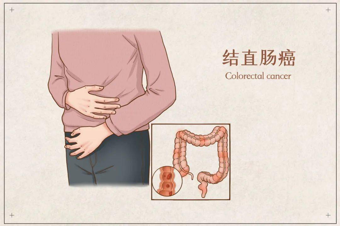 小息肉→大息肉→不典型增生→肠癌