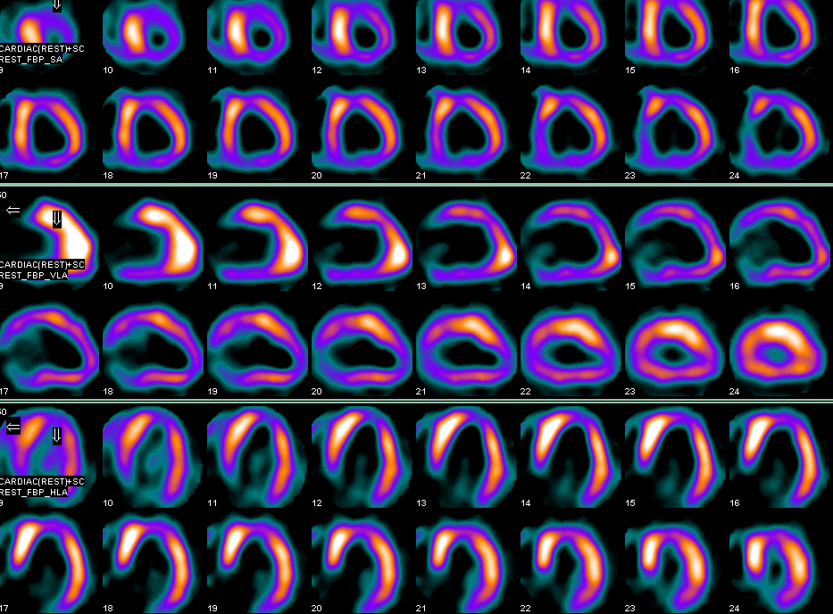 对冠脉微小血管病变和心肌炎的诊断和治疗随访具有较高的价值