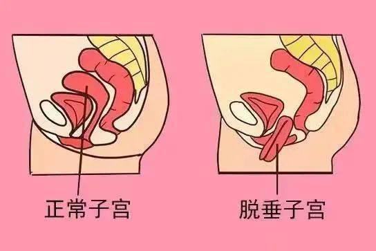 【新技术新项目】妙手实施盆底重建术,解六旬妇女难言隐疾_阴道_手术