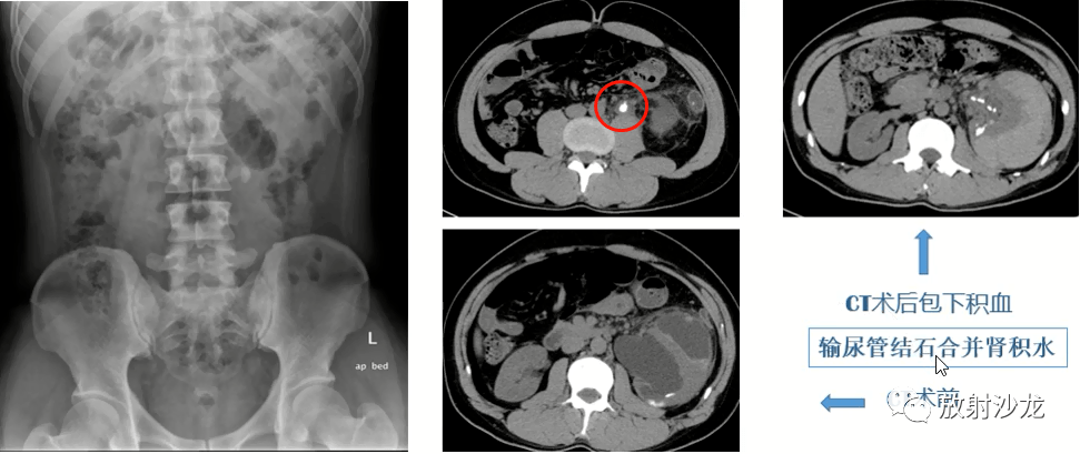 总结肾脏急性病变的影像诊断及鉴别_输尿管_病例_疾病