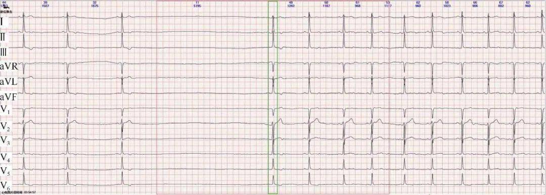 室性停搏心电图图片