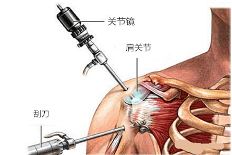 肩锁韧带断裂图片
