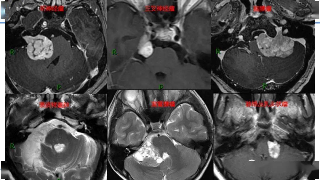 桥小脑角脂肪瘤图片