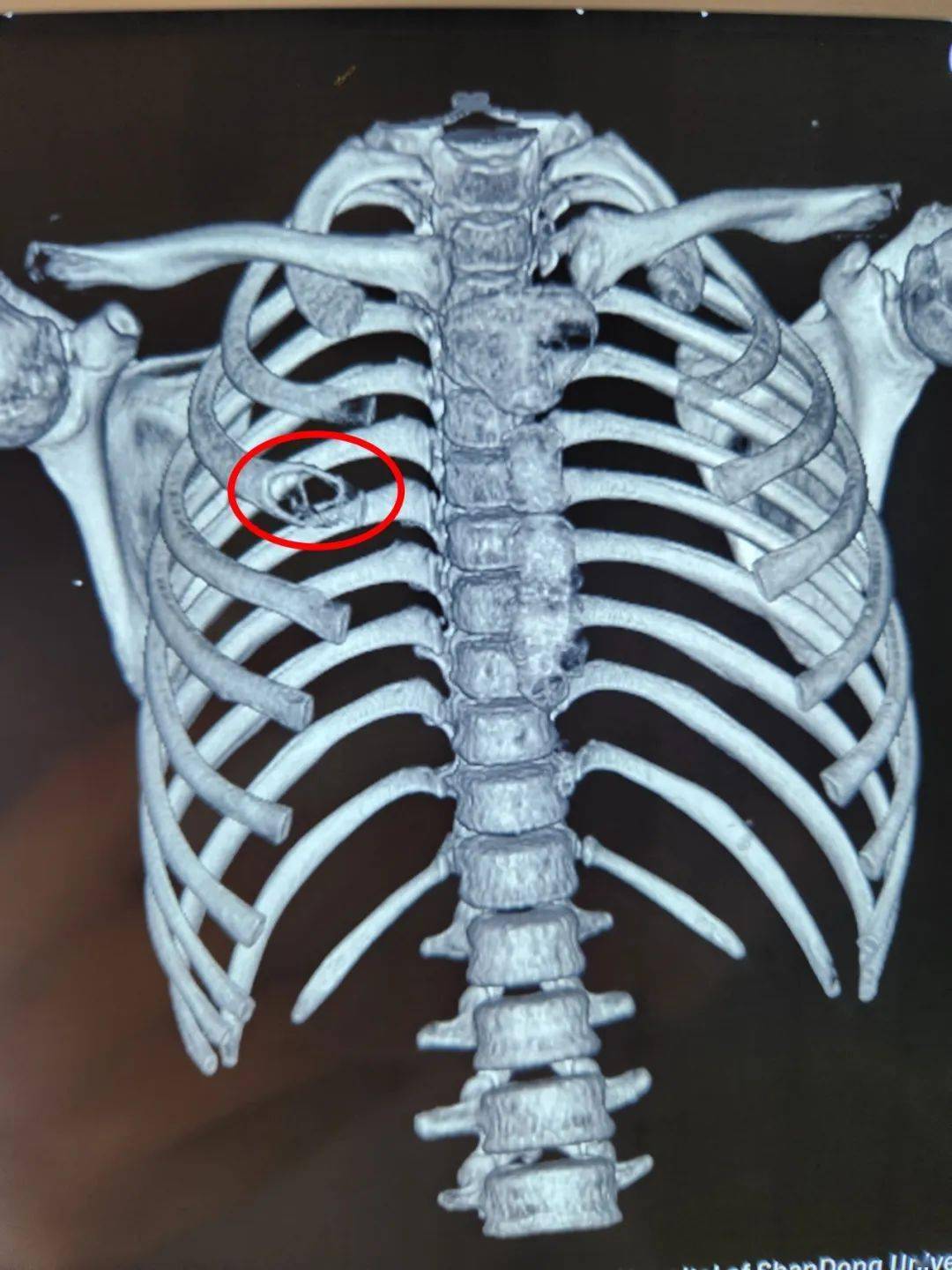 肋骨骨化性纤维瘤图片