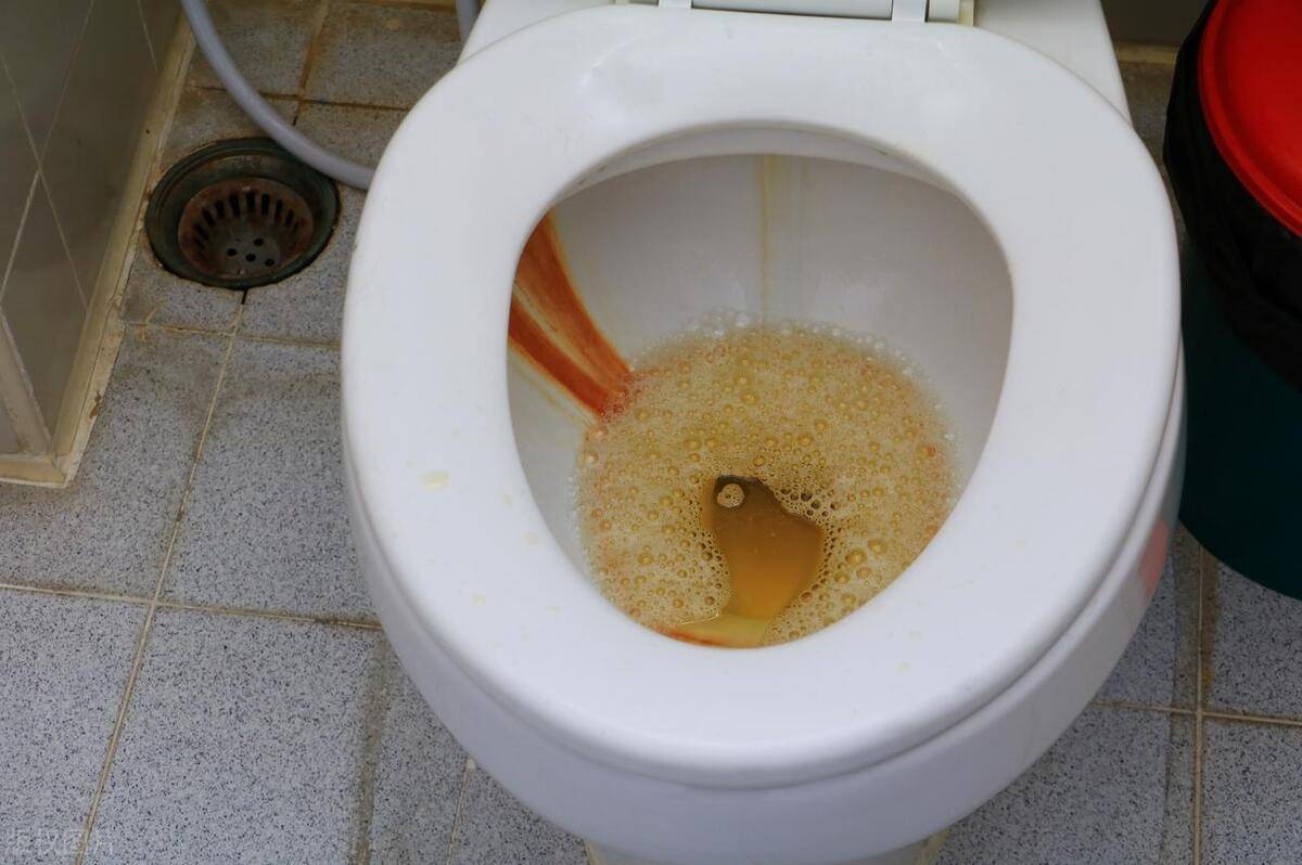 3, 尿液颜色异常一般来说,健康正常的尿液经尿液胆红素氧化后呈无色淡