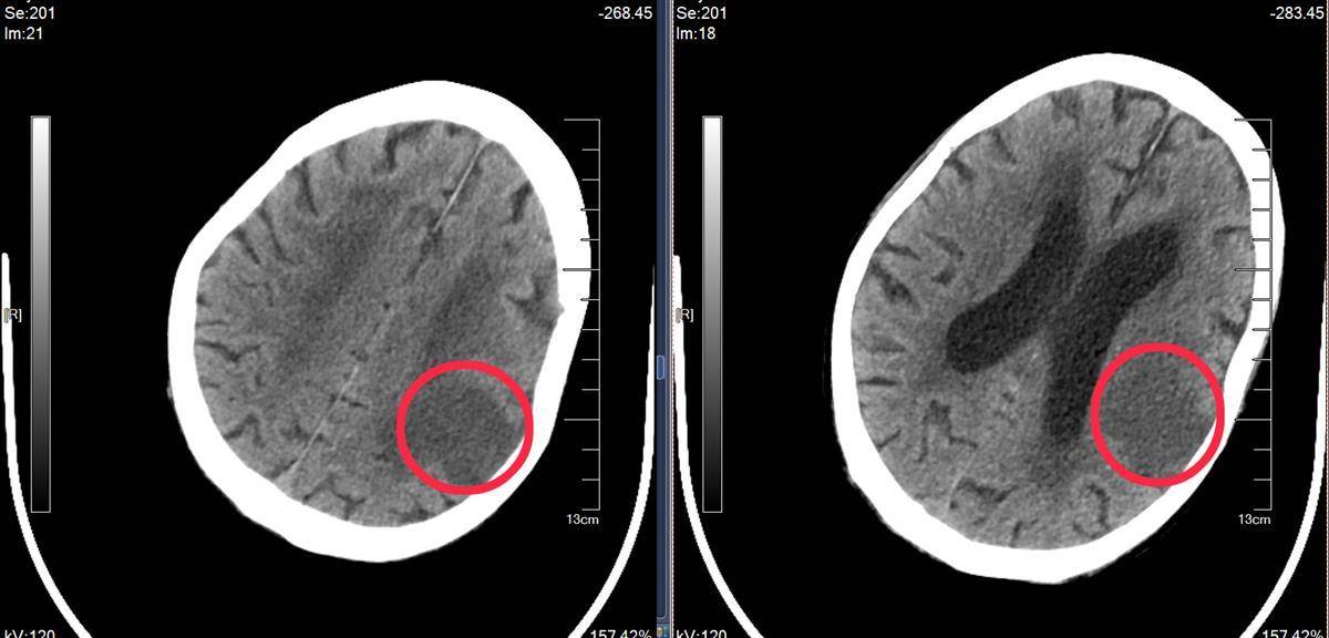 脑干梗死CT图片