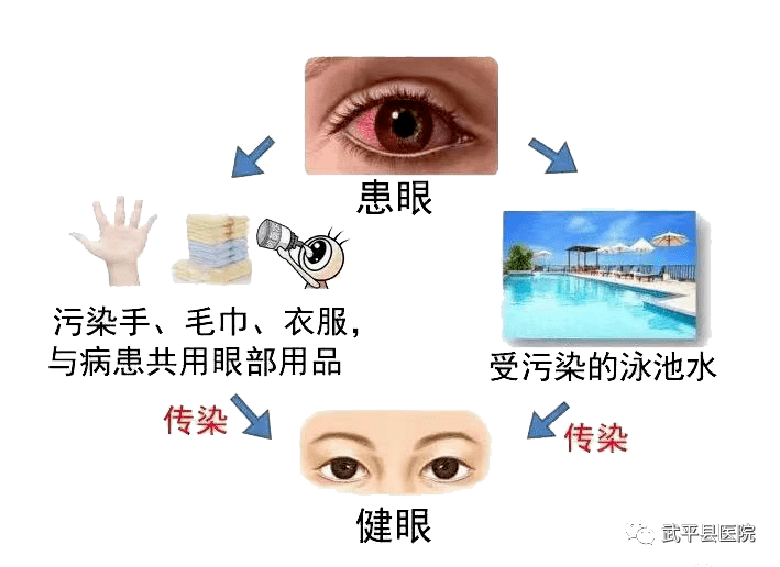 "红眼病"高发,武平县医院一天接诊近80人! 传播途径是.