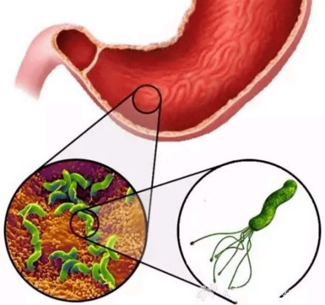 使正常的胃粘膜发生炎症改变,导致慢性胃炎,消化性溃疡,胃息肉,胃癌
