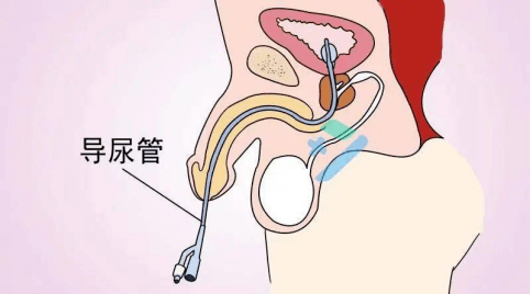 男生导管子是什么意思图片