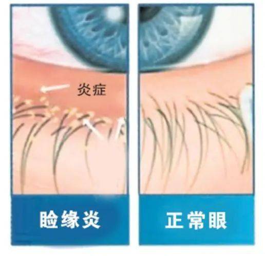 睫毛螨虫症状图片