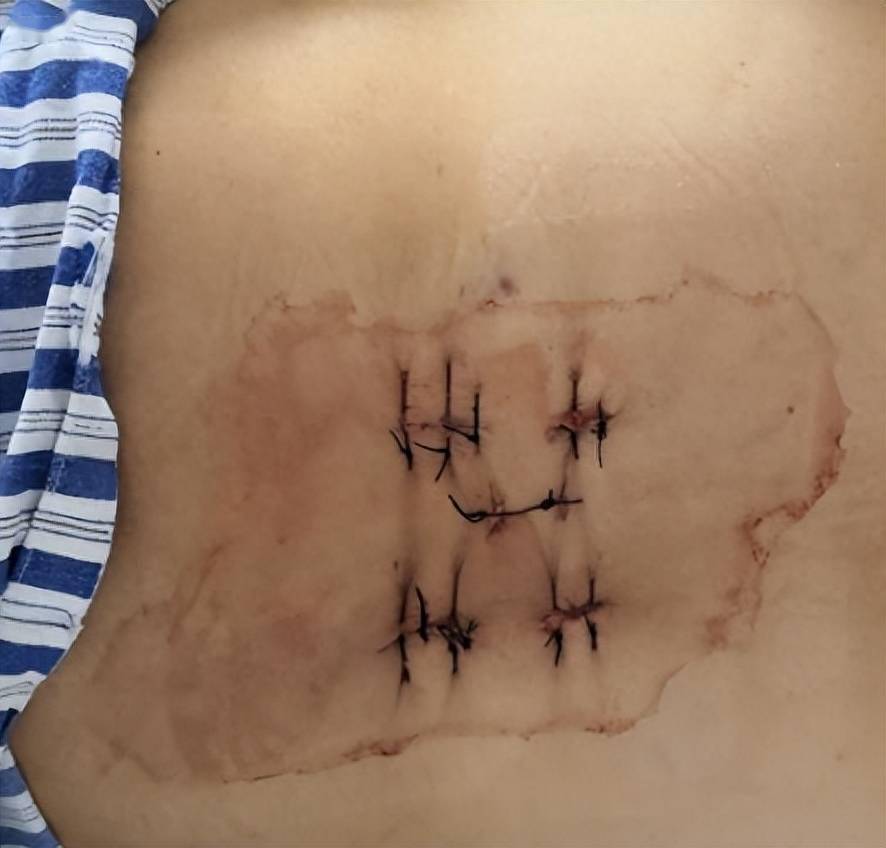 女子腰痛难忍20余年,医生仅凭8毫米小孔为其解腰部"大"问题_手术_阿姨