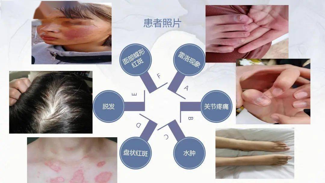 【ppt】与"狼"共舞——系统性红斑狼疮患者的护理查房_微信_侵权_版权