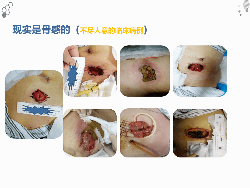 粪水性皮炎图片