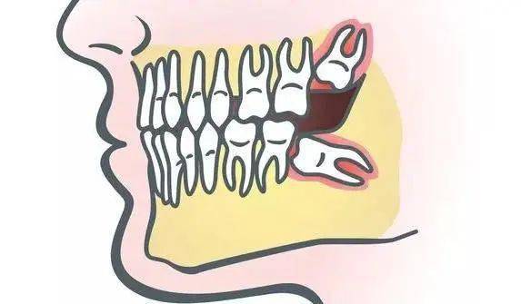智齒指人類牙槽骨最後的4顆第三磨牙,通常在20歲左右萌出.