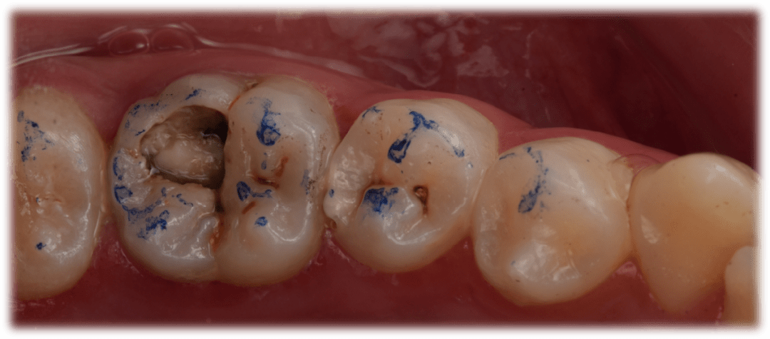 全国决赛12强病例展示 王林强 二类洞直接修复一例:右下五树脂充填