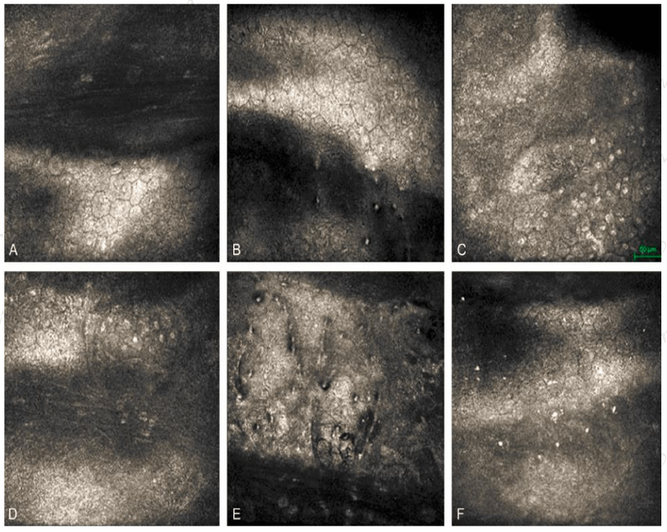听北京大学第一医院眼科晏晓明教授揭示谜团_角膜_donald_stone