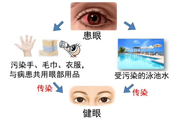 "红眼病"高发季,如何预防?_患者_传播_消毒