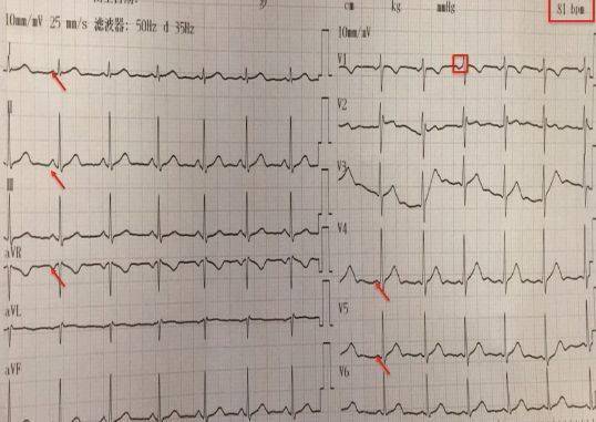 心电图如何诊断图片