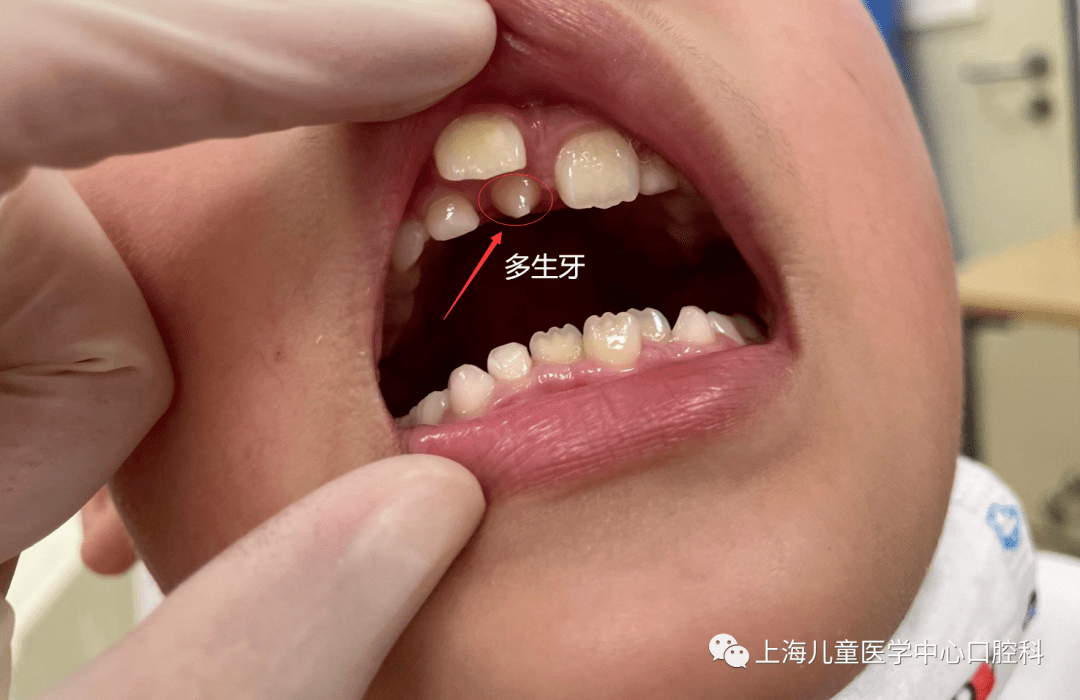 ​儿医小课堂 112 | 口腔里的不速之客