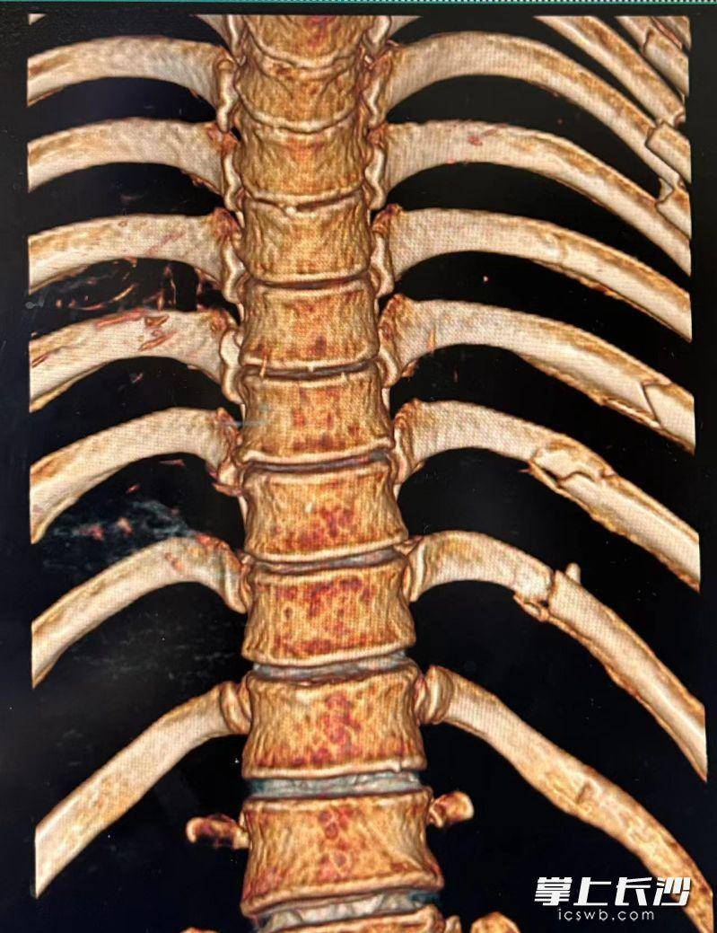 肋骨骨折图片 片子图片