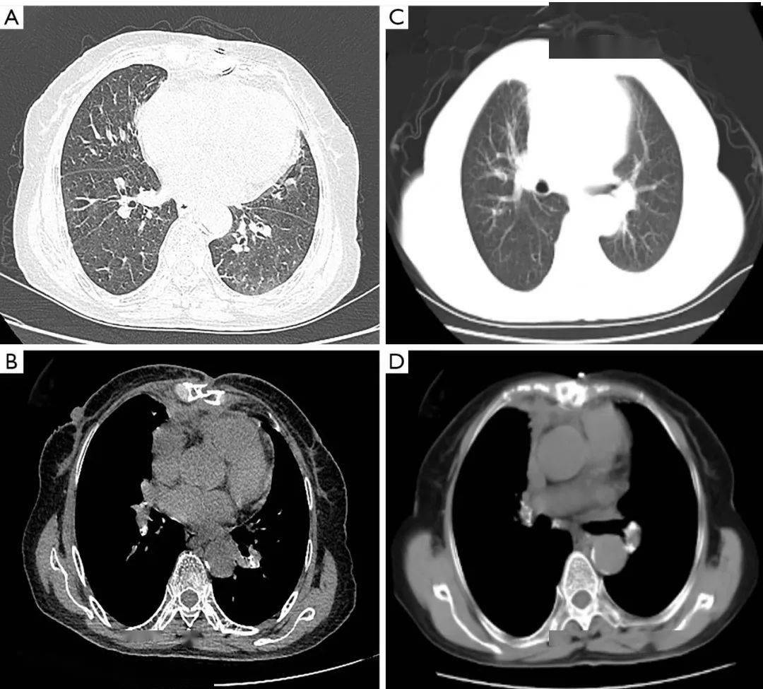 一例通过纵隔肿瘤切除诊断和治疗的心包间皮瘤病例|imdt 专栏_患者