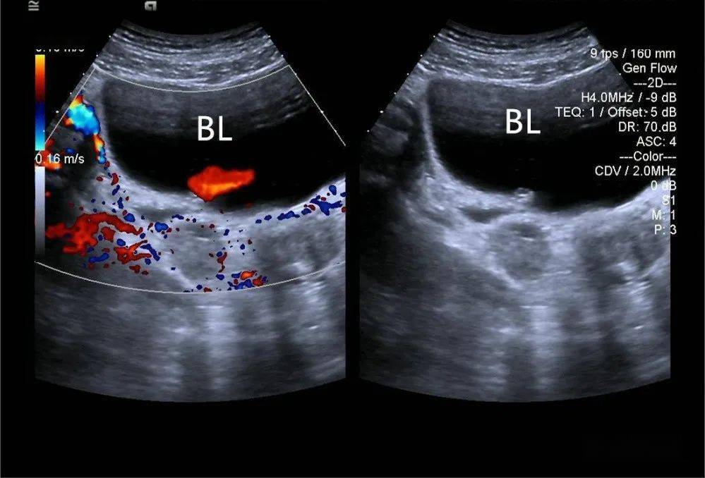 膀胱三角区超声图图片