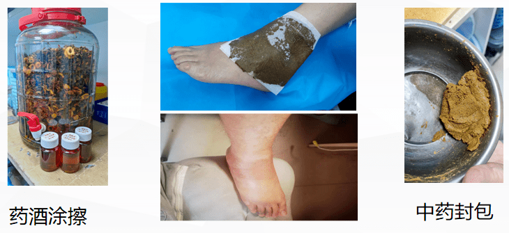 科普丨踝关节扭伤,不妨试试放血疗法_治疗_患者_活动