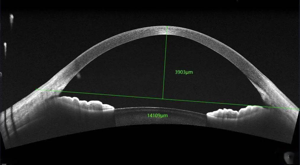 6mm)的巩膜镜,然后通过oct测量,确定患者初始试戴片矢高,进而确定首片