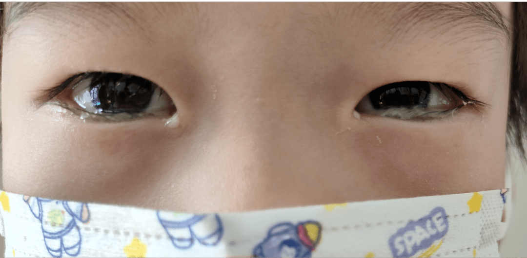 小孩眼睛肿是怎么回事图片
