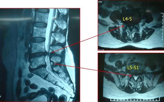 腰椎l5s1位置图片图片