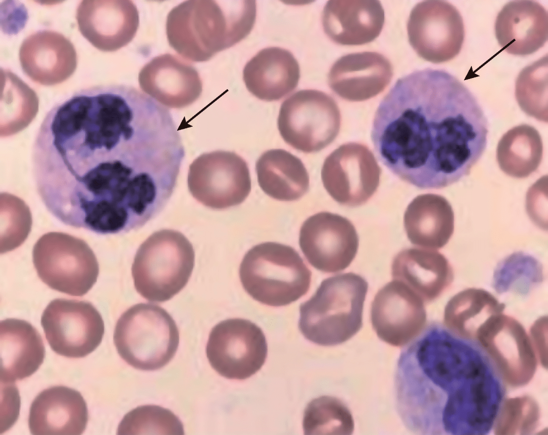 如何識別白細胞病理形態異常_中性_血細胞_顆粒