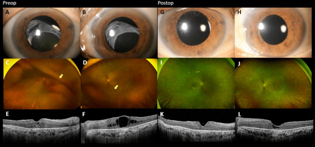 aao葡萄膜丨玻璃体切除术治疗慢性非感染性葡萄膜炎的远期疗效_视网膜