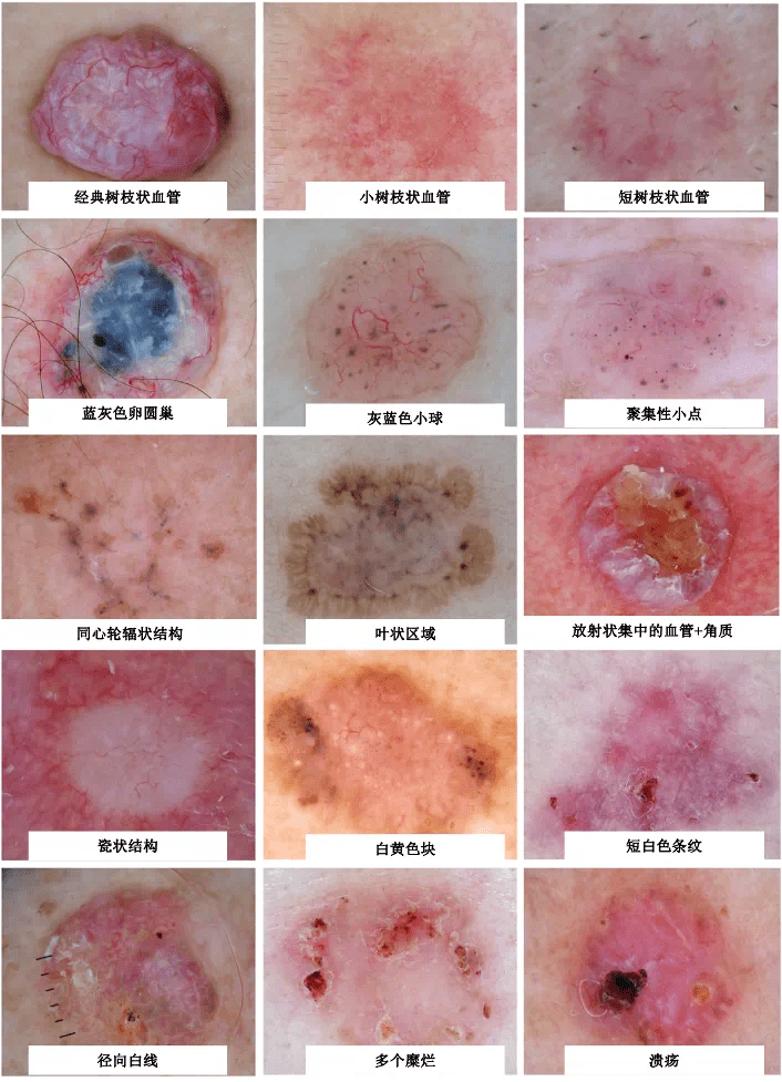 皮肤基底细胞癌在无创检查-皮肤镜下有着这样一些特殊表现:该病好发于