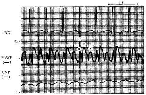 循环监测 | 心脏瓣膜病的血流动力学表现_曲线_患者_二尖瓣