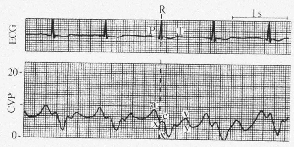 循环监测 | 心脏瓣膜病的血流动力学表现_曲线_患者_二尖瓣