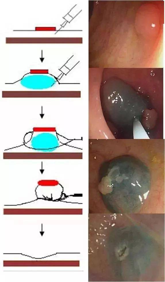 结直肠息肉内镜下切除术(华西版)_病变_黏膜_手术