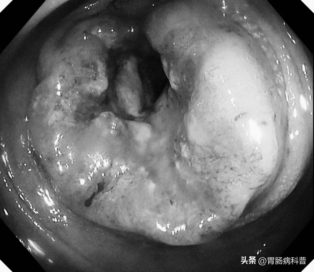 肠癌晚期照片图片