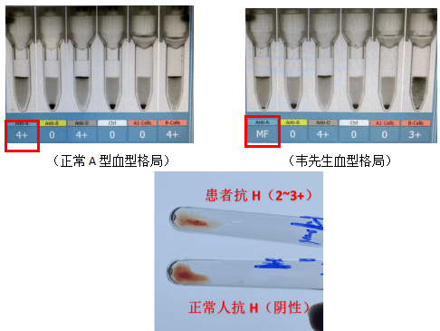 抗a抗b血型测试结果图图片