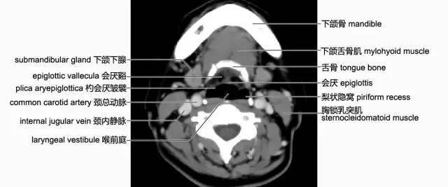 頸部影像解剖(必點收藏)_會厭_層面_頸椎