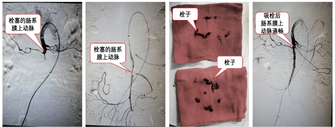 动脉_肠系膜_栓塞