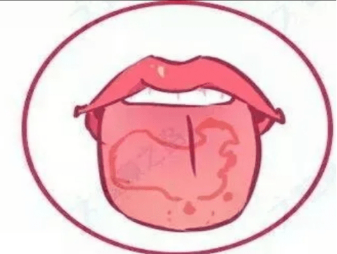 舌背上的部分舌乳头萎缩呈不规则的红斑区域,边缘则为丝状乳头增厚呈