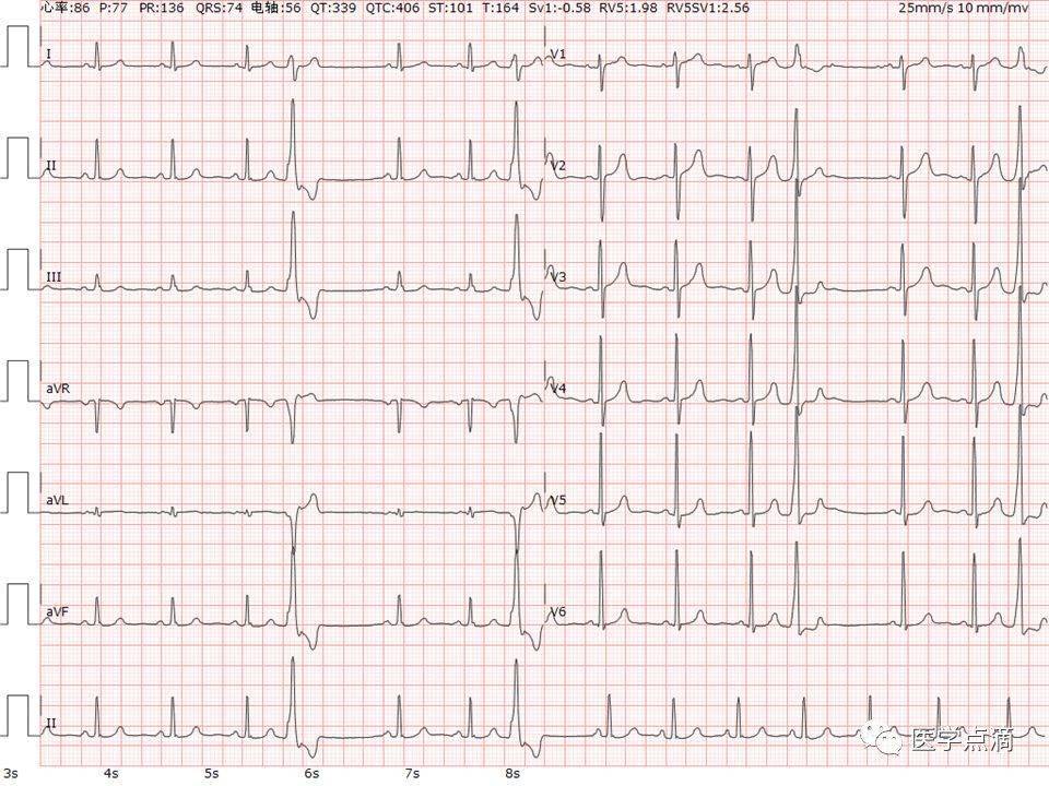 心室颤动q波正常情况下,Ⅱ,Ⅲ,avf可见,v6可见,v5,v4少见q波时相 0