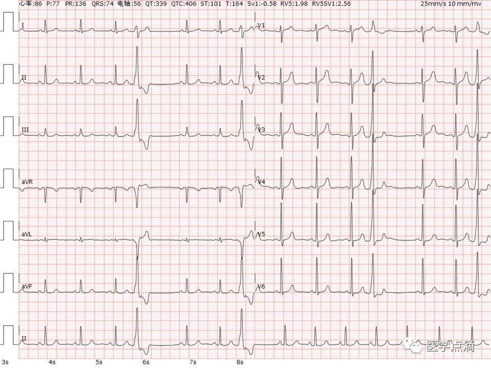 心电图rv6十sv2正常值图片