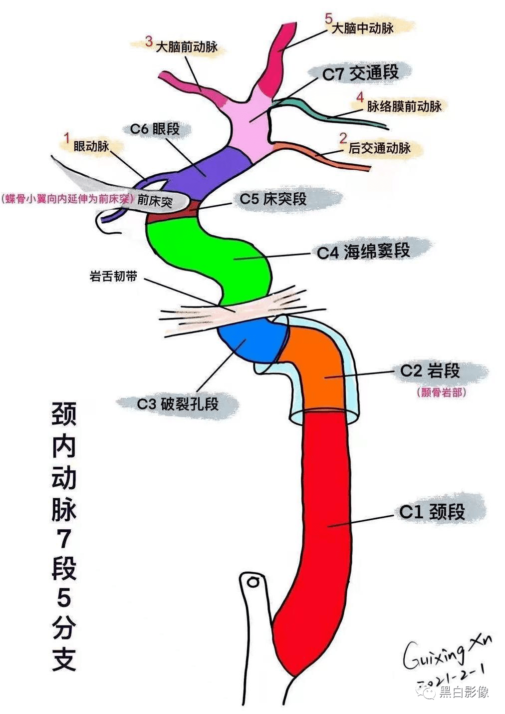 颈内动脉虹吸段示意图图片