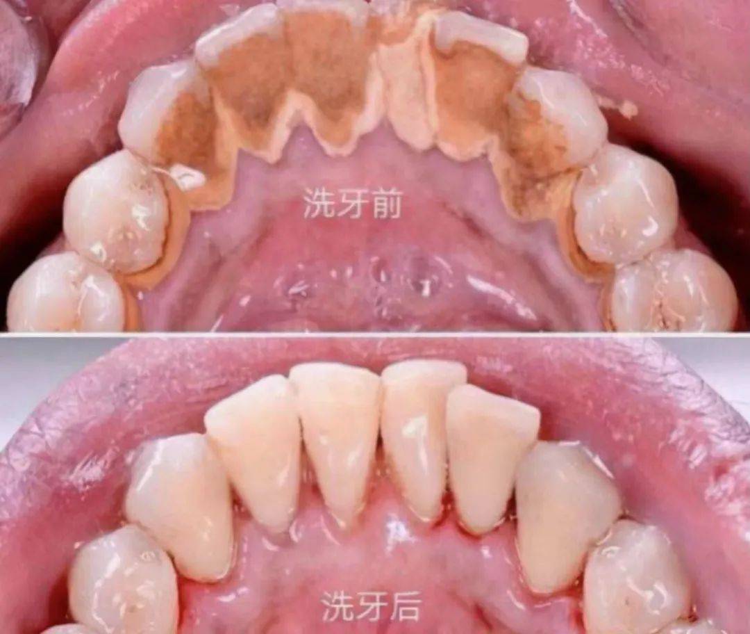 肿胀,洁牙后间隙和牙龈间的结石被清理掉,牙龈逐渐消肿,牙缝重新显露