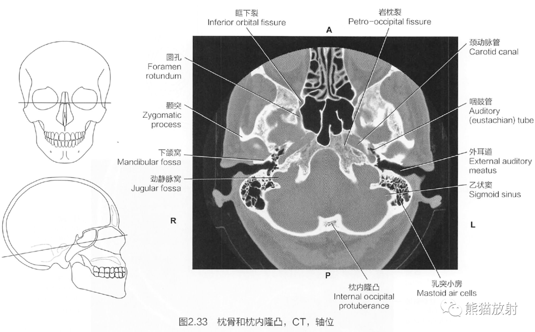 蝶骨三维图图片