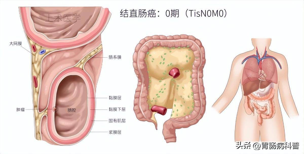 2019年直肠癌tnm分期图图片