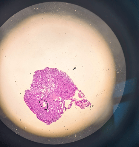 科普| 啥是胃底腺息肉?_病变_上皮_组织